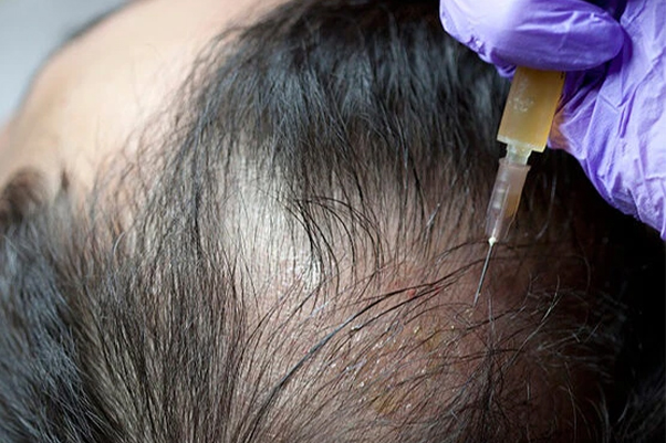 prp treatment